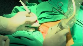 OP UVODJENJE CENTRALNIH VENSKIH KATETERA ZA HEMODIALIZU POMOĆU ULTRAZVUKA – Vimeo thumbnail